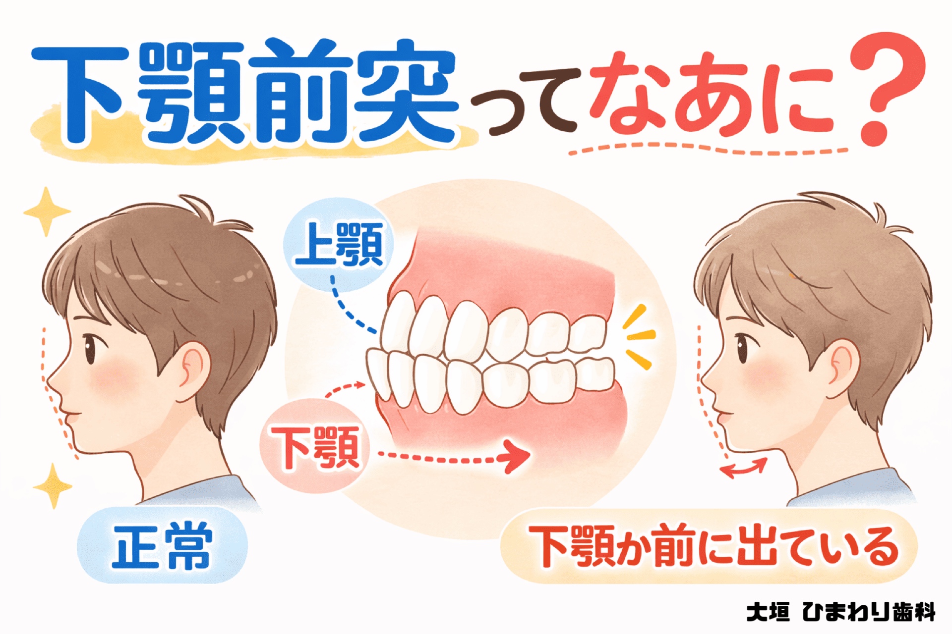 ‍下顎前突って？